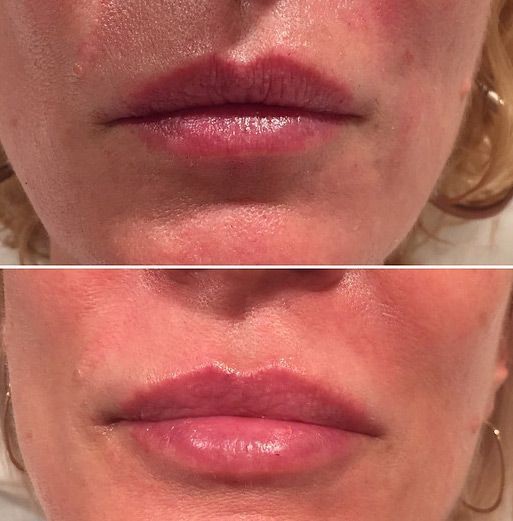 Juvederm Lip Injections