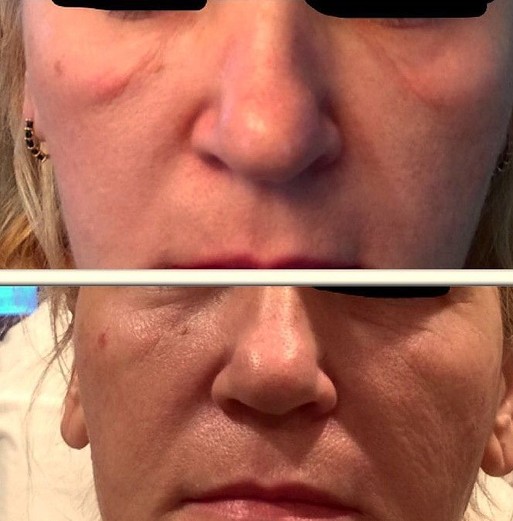 Juvederm Injections for Festoons