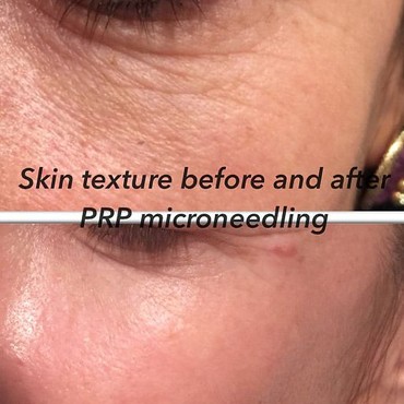 PRP With Microneedling Miracle