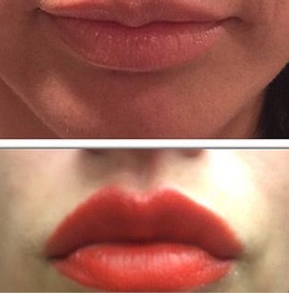 Juvederm Lip Enhancement