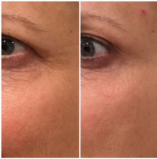 Before and after Plasma Fibroblast Treatment