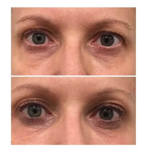 Before and after Plasma Fibroblast Treatment