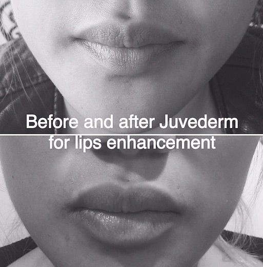 Juvederm Lips Volume Correction