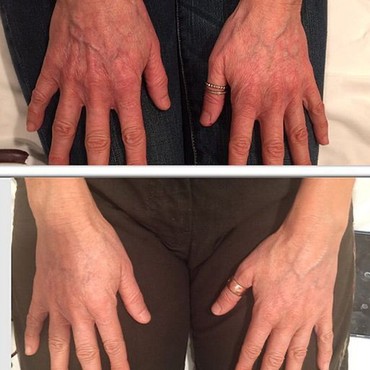 Radiesse Hands Injections for Volume