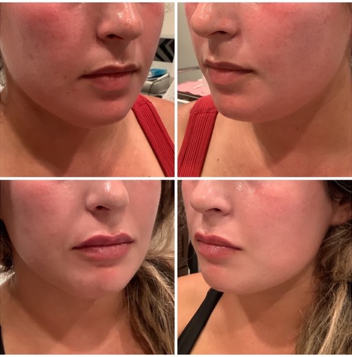 Before and after Restylane Kysse