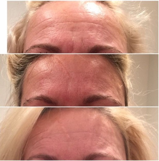 Botox Before and After 3 months and 8 months