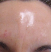 Forehead After Botox Injections