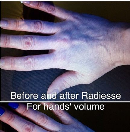 Radiesse for Hands Volume