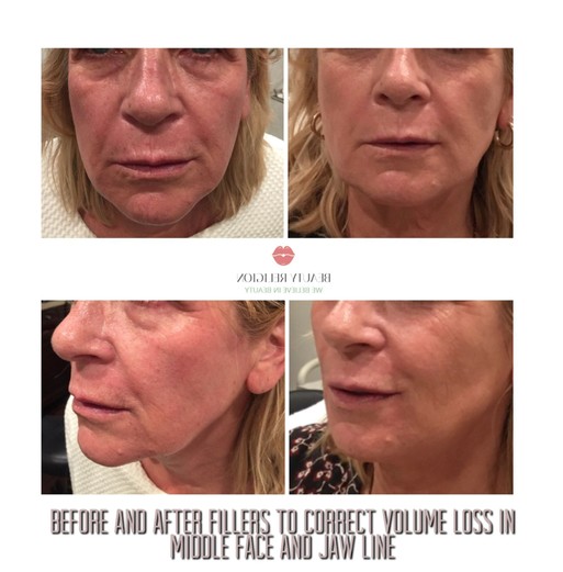 Facial volume restoration, augmentation and sculpting with Fillers