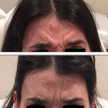 Botox Relaxation of Frown