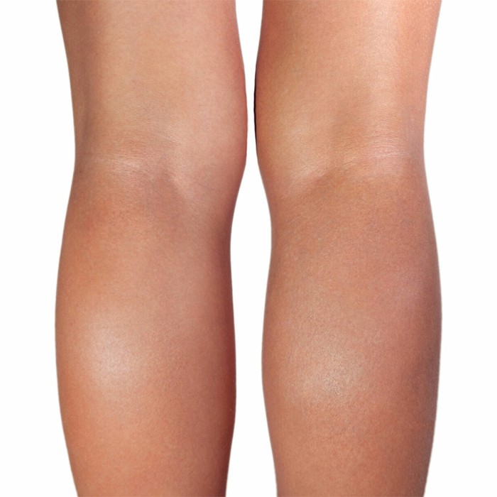 after sclerotherapy for varicose veins