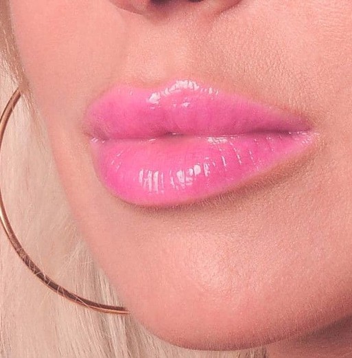 Juvederm Lips enhancement