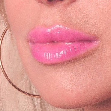 Juvederm Lips enhancement