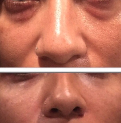 Under Eye Bags Before & After Juvederm
