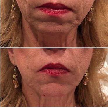 Fillers to correct jaw line