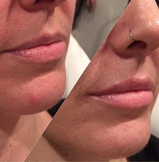Before and After Juvederm Injections