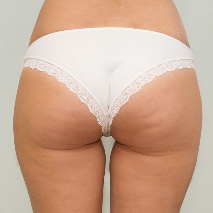 before qwo injections for cellulite