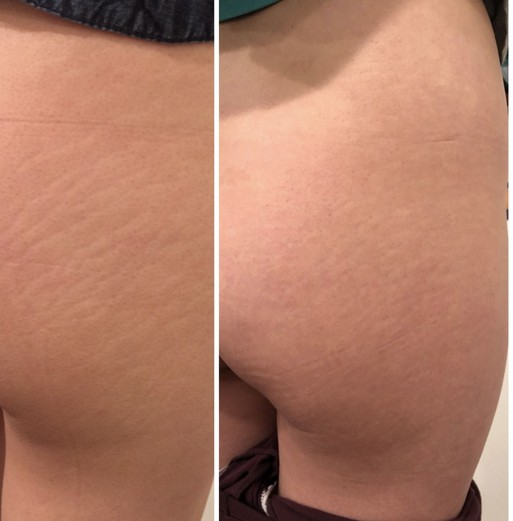 Carboxytherapy for Stretch Marks