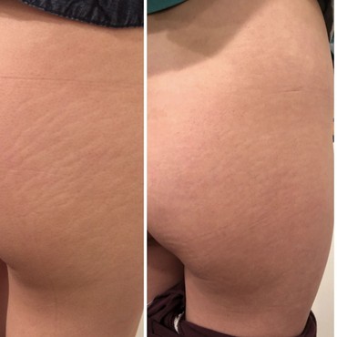 Carboxytherapy for Stretch Marks