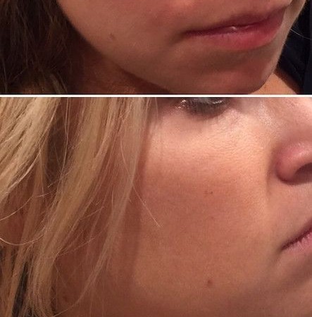 Tear Trough Juvederm Before and After