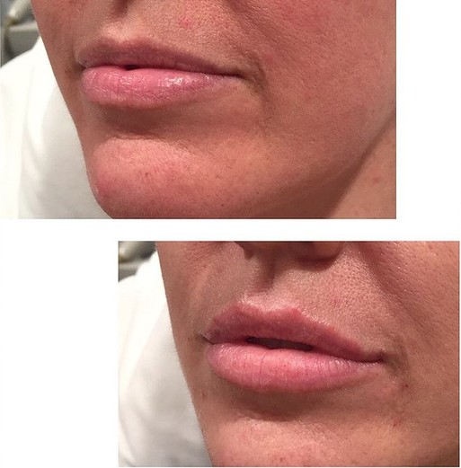Juvederm Lip Enhancement