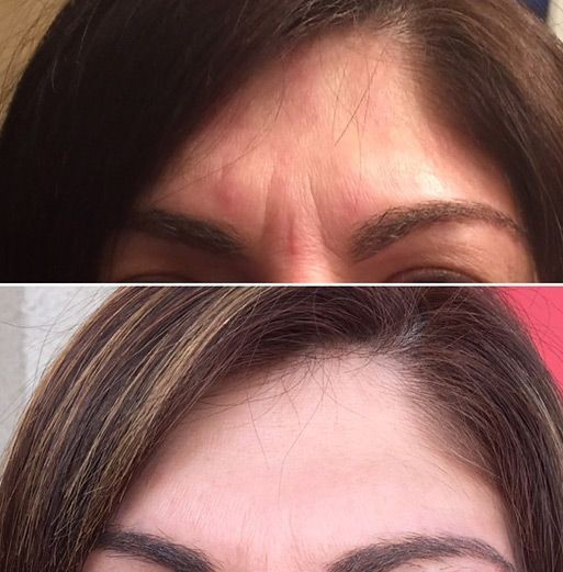 Botox Before and After 1 week