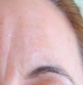 Forehead Lines, Grooves before Botox