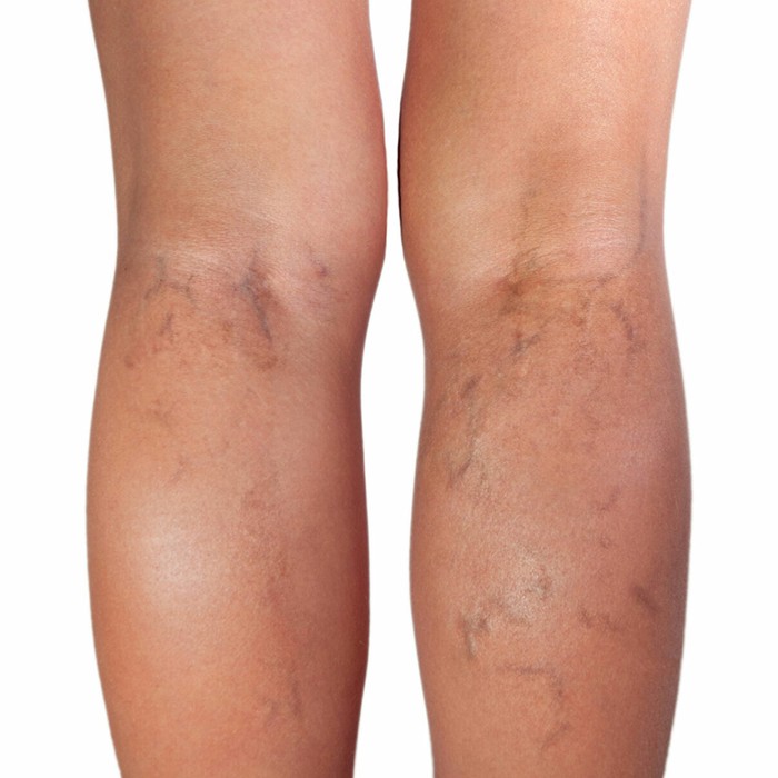 before sclerotherapy for varicose veins