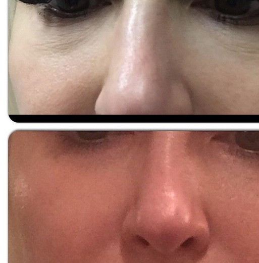 PRP with Microneedling Miracle