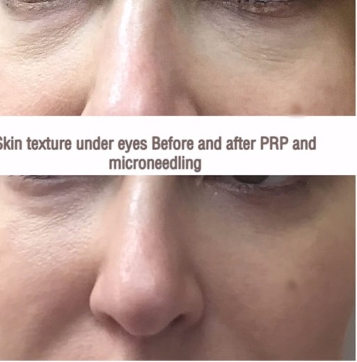 PRP with Microneedling