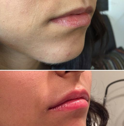 Juvederm in Lips Before and After